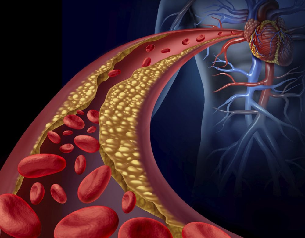 cholesterol1